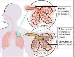 COPD 2