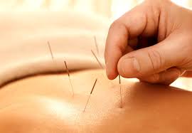 acupuncture