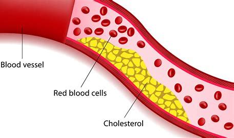 high cholesterol
