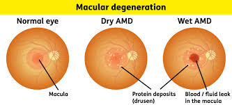macular degeration
