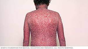 psoriasis