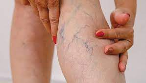 varicose veins