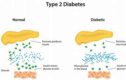 Type 2 Diabetes