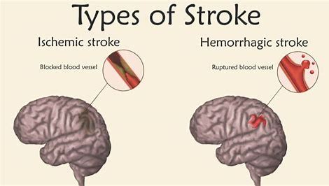 kinds of stroke