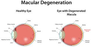 macular degeration