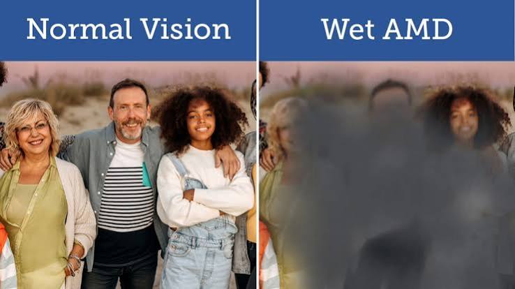 macular degeneration 3 macular degeneration 3