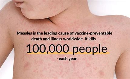 measles